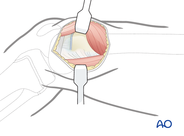 Retracting the vastus medialis anteriorly