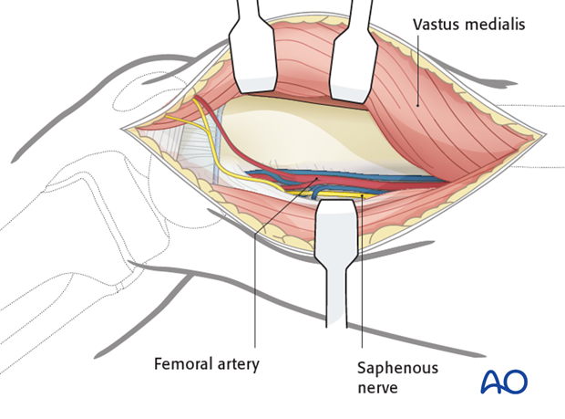 Blunt dissection deep to adductor magnus for exposure of the popliteal neurovascular bundle