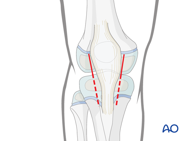 Skin incision of a lateral and medial parapatellar arthrotomy