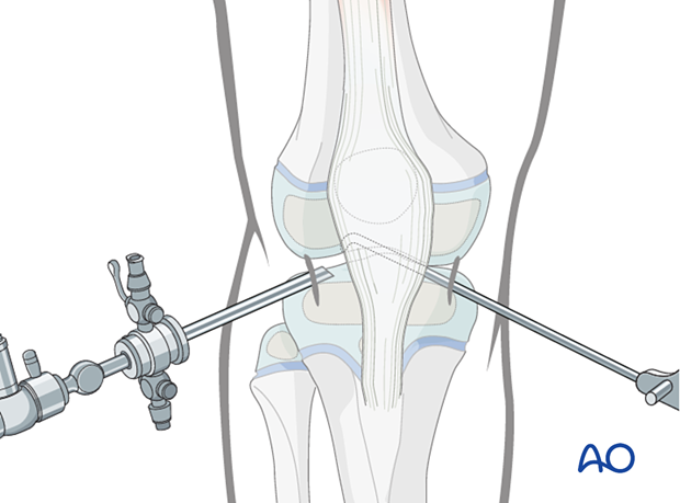 Standard arthroscopic approach to the knee with anteromedial and anterolateral portals