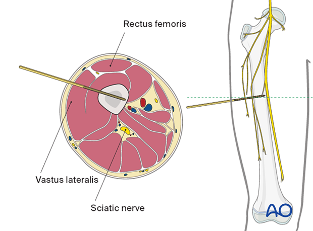 Direct lateral approach