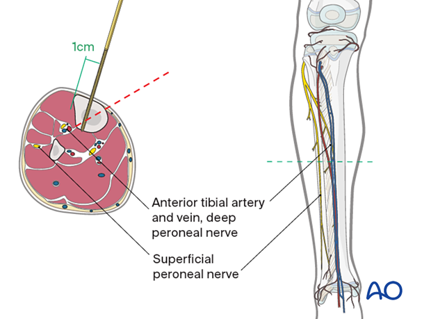 Safe zone for pin insertion in the midshaft of the tibia