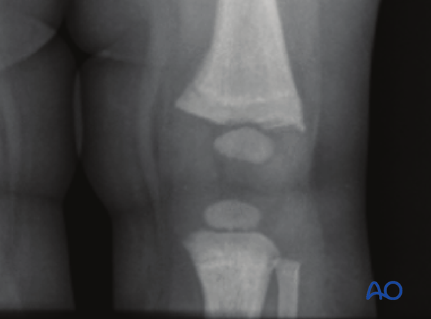 X-ray of a metaphyseal corner fracture