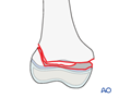 33-E/2 Epiphysiolysis with metaphyseal wedge, SH II