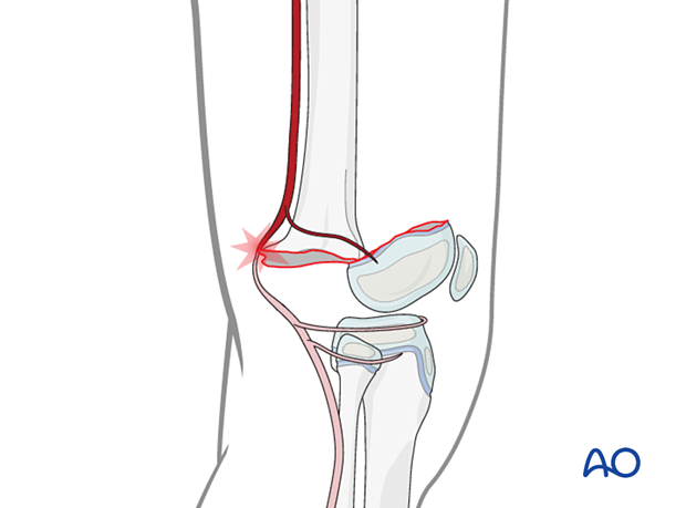 Injury of the popliteal artery