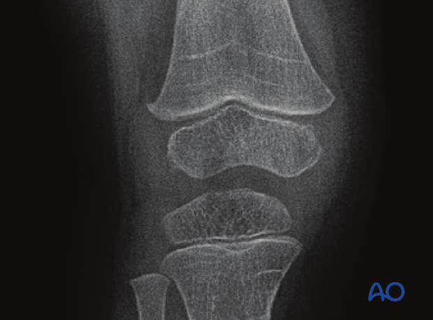 X-ray showing complete Harris lines in the metaphysis