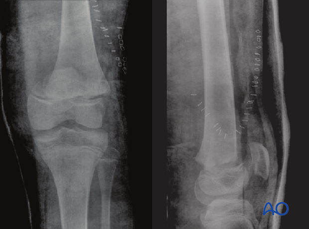 X-ray of a partially reduced Salter-Harris II fracture with a small medial metaphyseal fragment