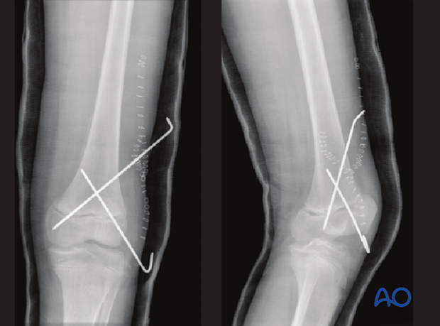 Anatomic reduction and fixation with smooth K-wires