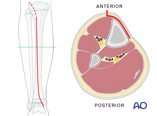 Approach to the anteromedial tibial surface in the child