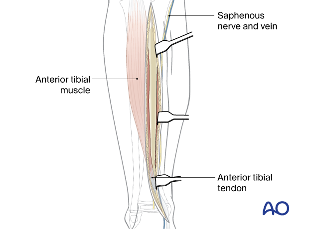 Approach to the anteromedial tibial surface in the child - Dissection