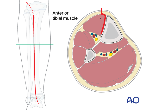 Approach to the anterolateral tibial surface in the child – Skin incision