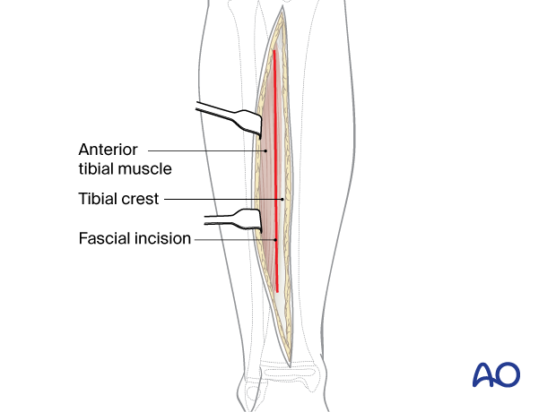 Approach to the anterolateral tibial surface in the child – Dissection