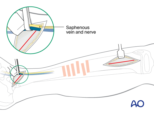 Minimally invasive medial approach to the pediatric tibia – Protection of saphenous vein and nerve