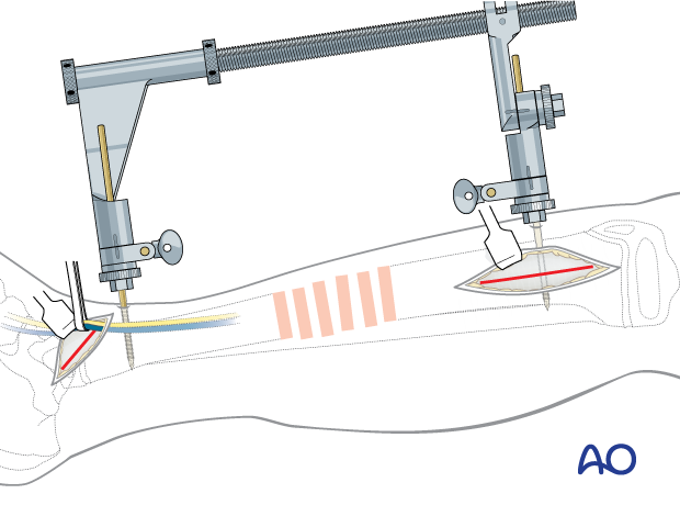 Minimally invasive medial approach to the pediatric tibia – Protection of saphenous vein and nerve and large distractor applied