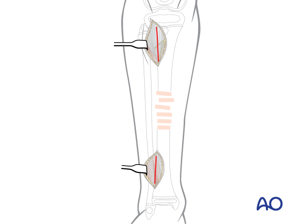 Minimally invasive lateral approach to the pediatric tibia - Deep dissection