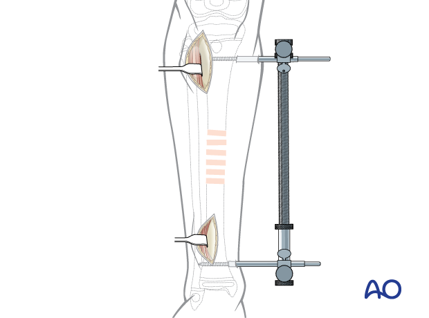 Minimally invasive lateral approach to the pediatric tibia – Large distractor applied