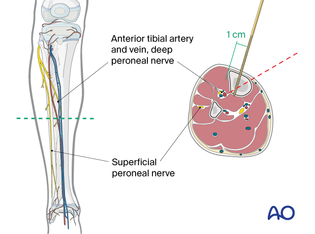 Safe zones for pin placement in the pediatric tibia – Pin insertion in the middle third