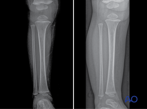 AP and oblique x-rays of a toddler’s fracture