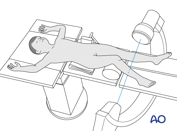 Supine position of a pediatric patient for surgery of the tibial shaft - C-arm positioning