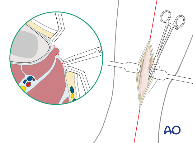 Dissection of the superficial posterior compartment fascia in the pediatric lower leg