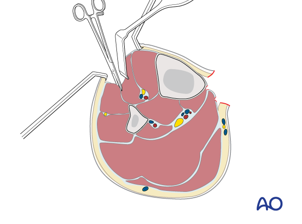 p42 X030 Compartment syndrome