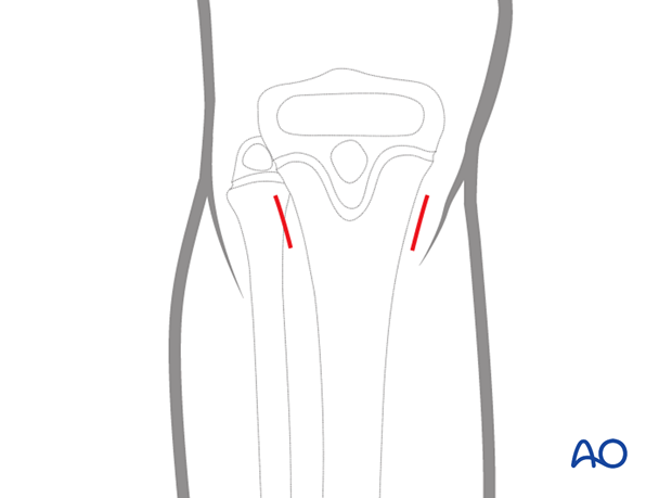 Skin incision to approach the entry points for antegrade elastic nailing of the pediatric tibia