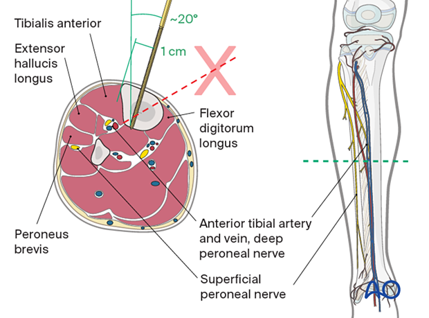 Safe zone for pin insertion in the midshaft of the tibia