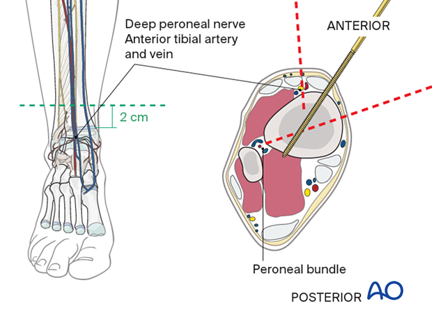 Safe zones for pin placement in the distal pediatric tibia