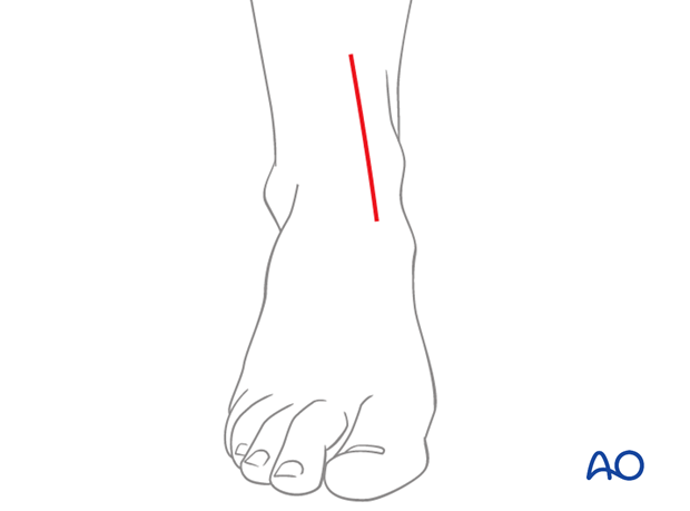 Skin incision for an anteromedial approach to the pediatric distal tibia