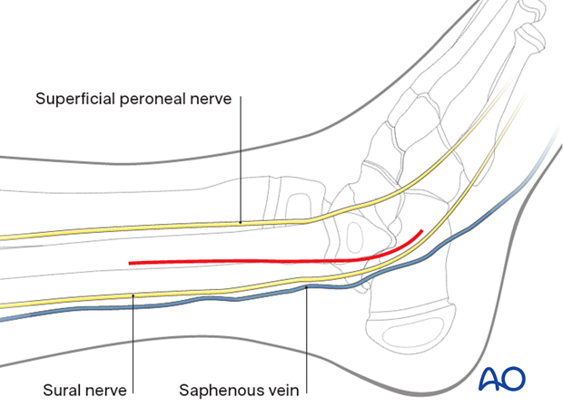 Skin incision for a lateral approach to the pediatric distal fibula