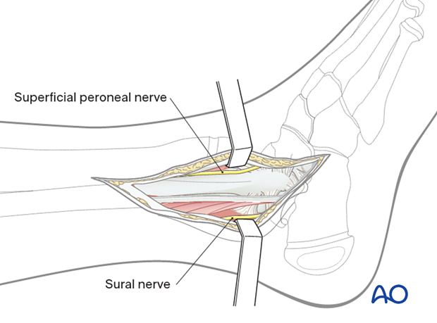 Surgical dissection to the pediatric distal fibula