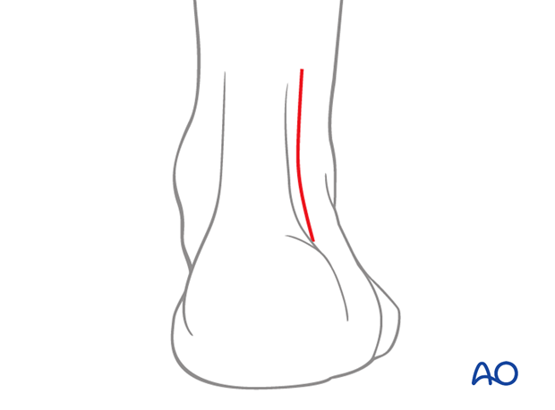 Skin incision for the posterolateral approach to the pediatric distal tibia