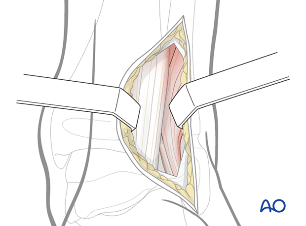 Dissection through the skin and the subcutaneous tissues of the pediatric distal tibia