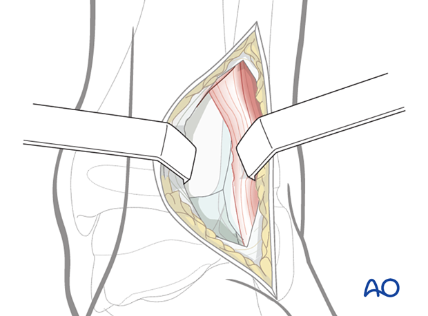 Exposure of the posterior and posterolateral pediatric distal tibia