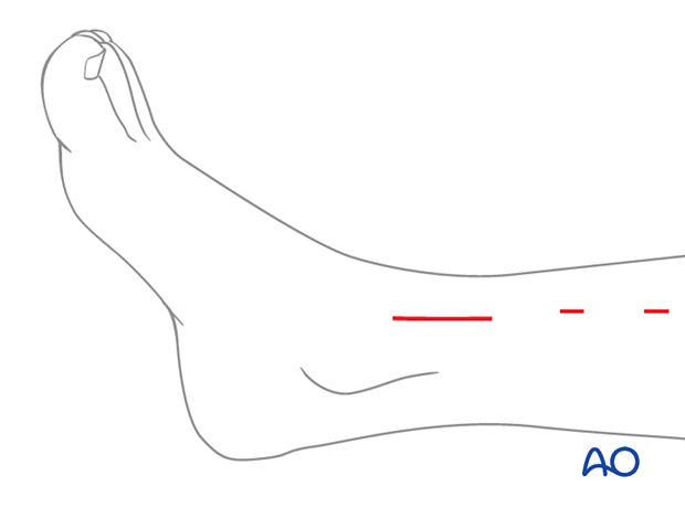 Skin incision of a minimally invasive approach for plating of the pediatric distal tibia