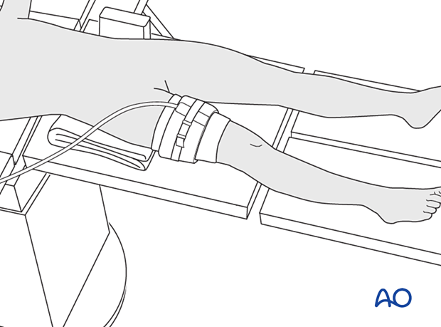 Tourniquet at the thigh of a pediatric patient in supine position