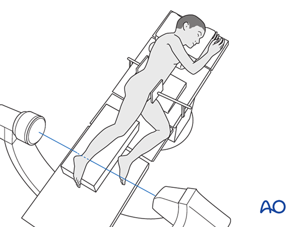 Lateral decubitus position of a pediatric patient for intraoperative imaging of the distal tibia and fibula