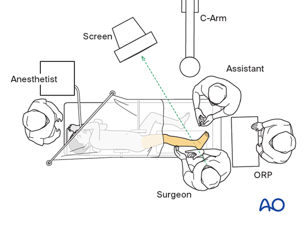 OR set-up for operation of the distal tibia and fibula of a pediatric patient in lateral decubitus position