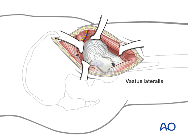 Retract the muscle inferiorly. Adjust the retractors as necessary and debride periarticular fat to expose the hip capsule.