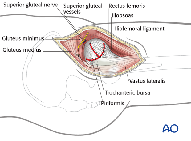 Perform a meticulous debridement of all soft tissues before starting wound closure