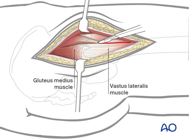 Divide the fascia lata over the greater trochanter, extending it distally over the proximal femoral shaft and proximally