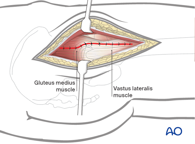 Heavy sutures, typically placed through holes in the bone, are used to reattach the anterior flap to the intertrochanteric ...