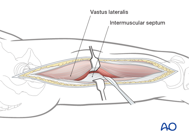 Mobilization of vastus lateralis