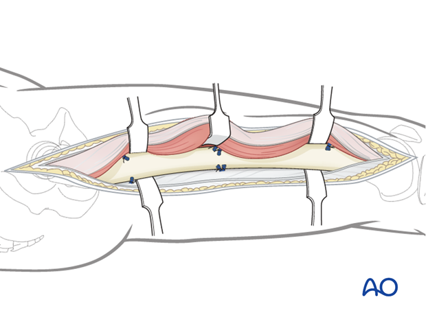 Exposure of femoral shaft