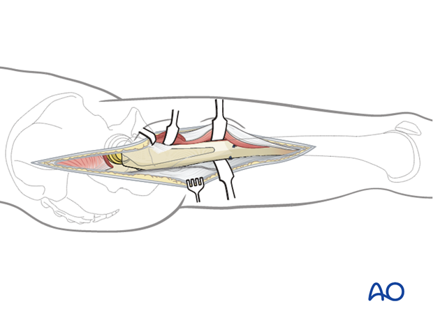 posterolateral approach extension