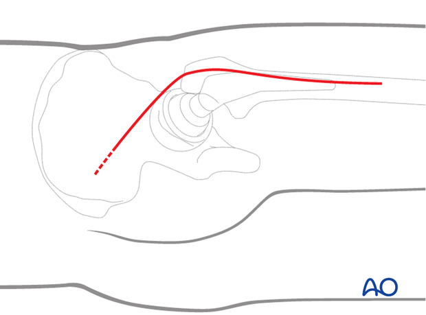 Skin incision for Kocher-Langenbeck approach to the hip