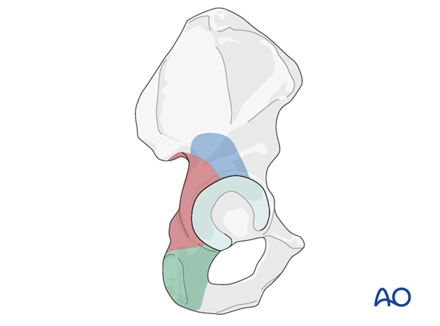 Exposure with Kocher-Langenbeck approach to the hip