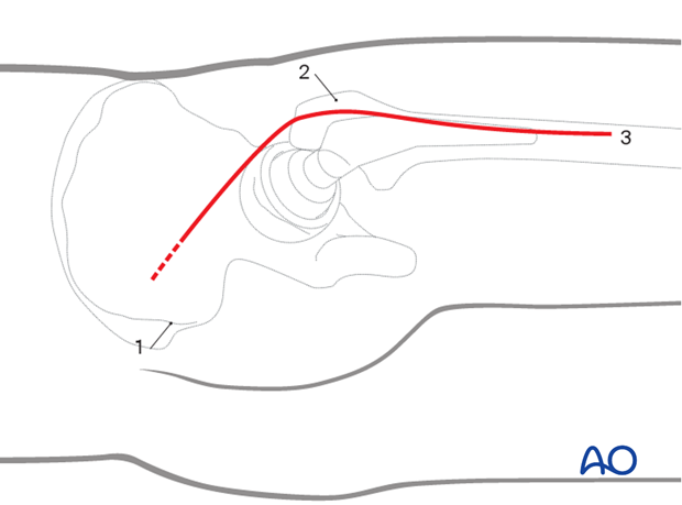 Skin incision landmarks for Kocher-Langenbeck approach to the hip