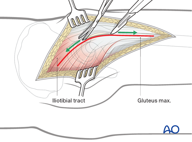 Fascial incision in a Kocher-Langenbeck approach to the hip