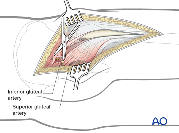 Surgical dissection in a Kocher-Langenbeck approach to the hip